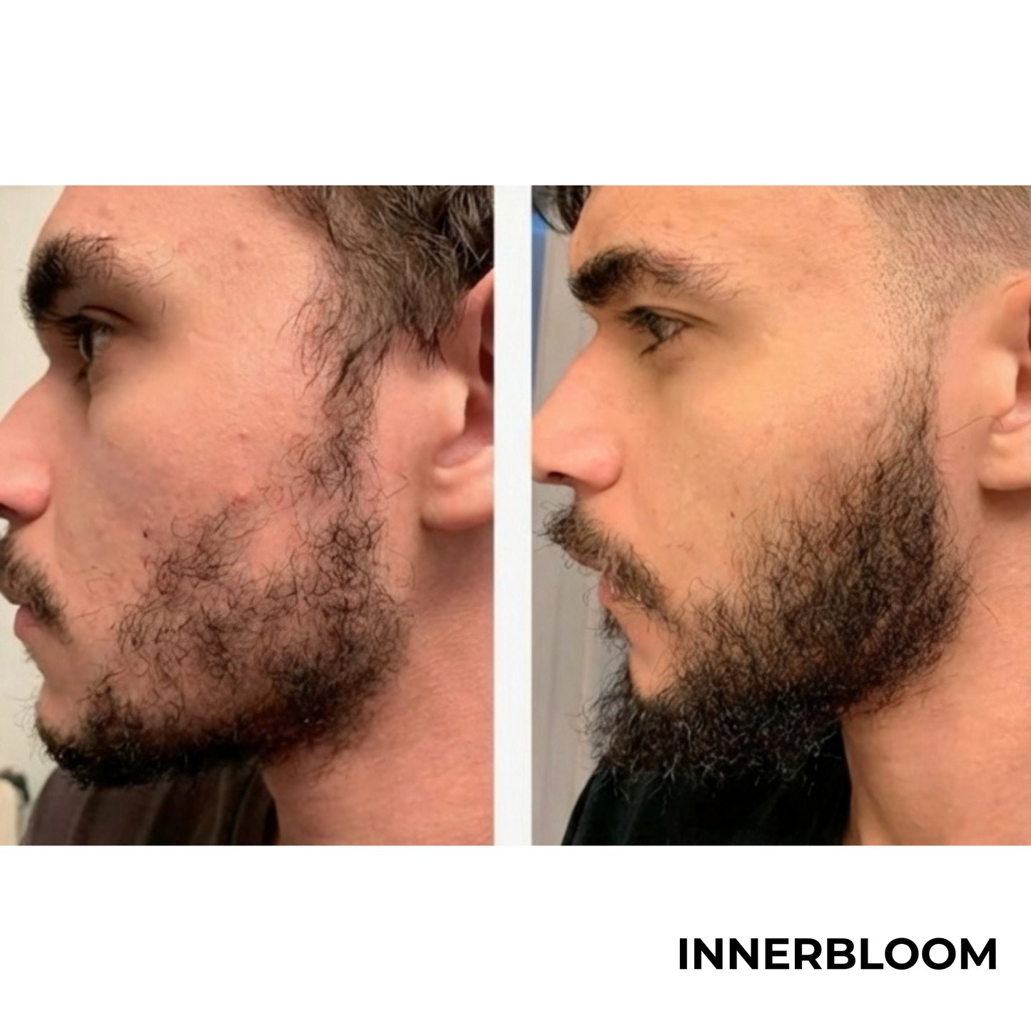 Innerbloom™ Beard Growth Roller with 5% Minoxidil & Rosemary Oil