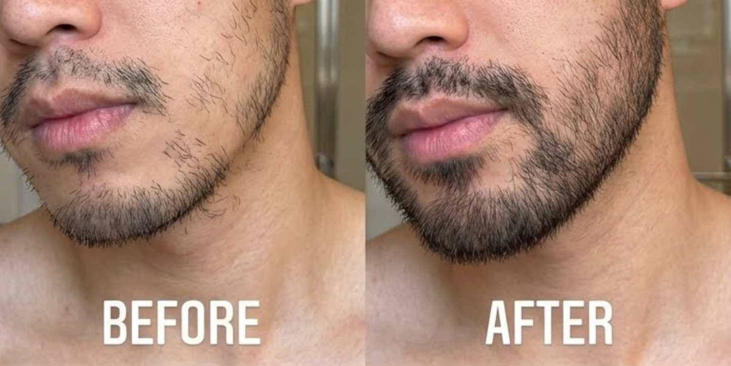 Innerbloom™ Beard Growth Roller with 5% Minoxidil & Rosemary Oil (Pack of 2)