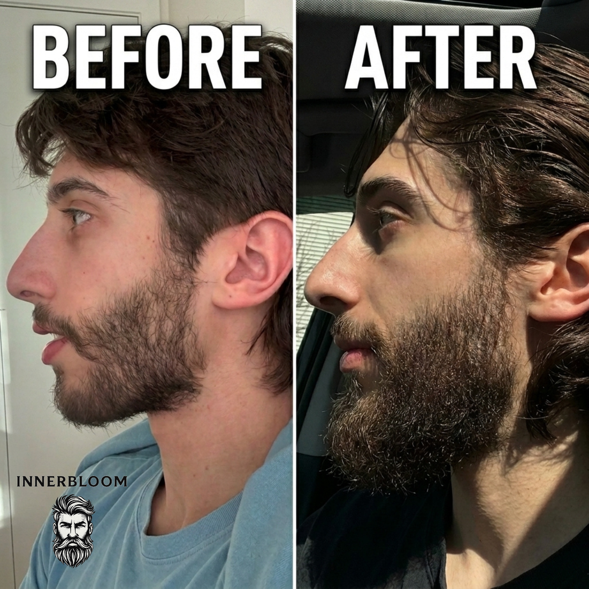 Innerbloom™ Beard Growth Roller with 5% Minoxidil & Rosemary Oil
