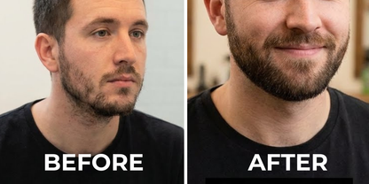 Innerbloom™ Beard Growth Roller with 5% Minoxidil & Rosemary Oil (Pack of 2)